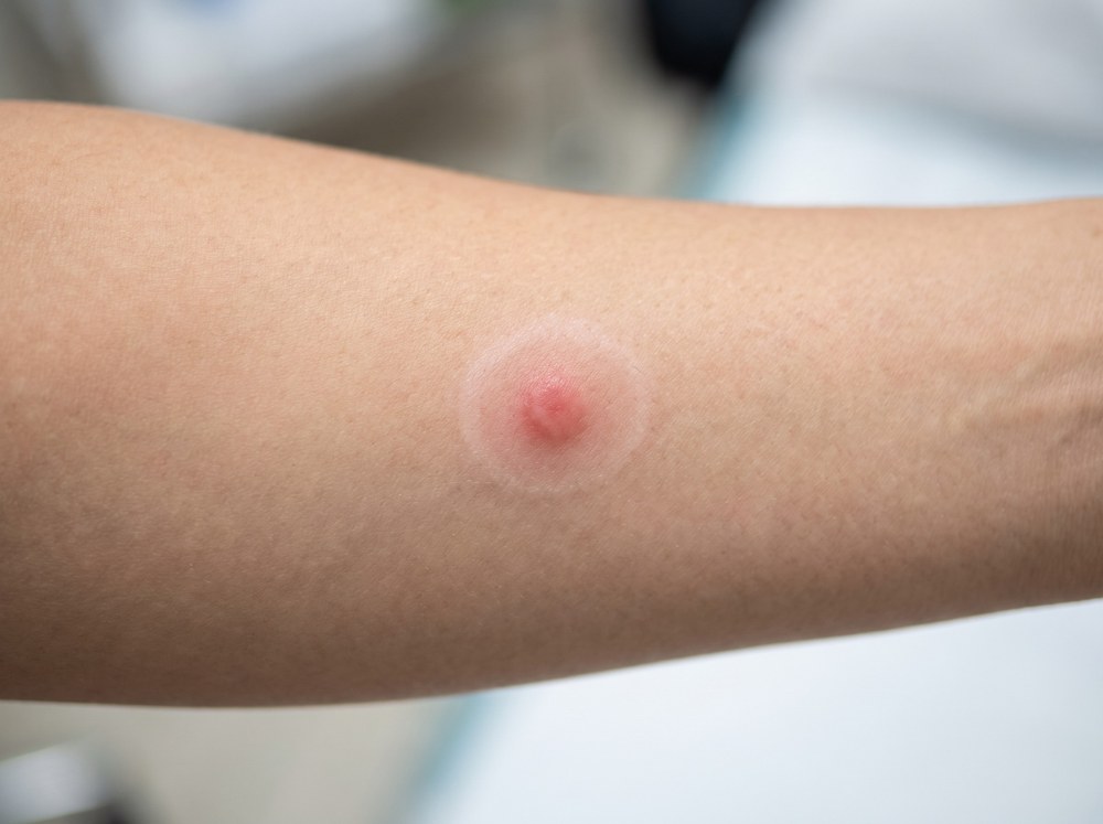 Close-up photograph of a fresh bite mark on skin showing two small puncture points with mild surrounding redness and slight swelling